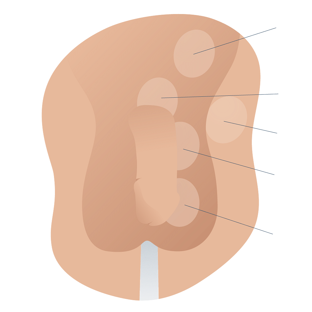 Maldescended Testicles – Andromedi Maldescended Testicles – Andromedi